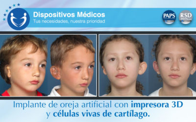 Implante de oreja artificial con impresora 3D y células vivas de cartílago.