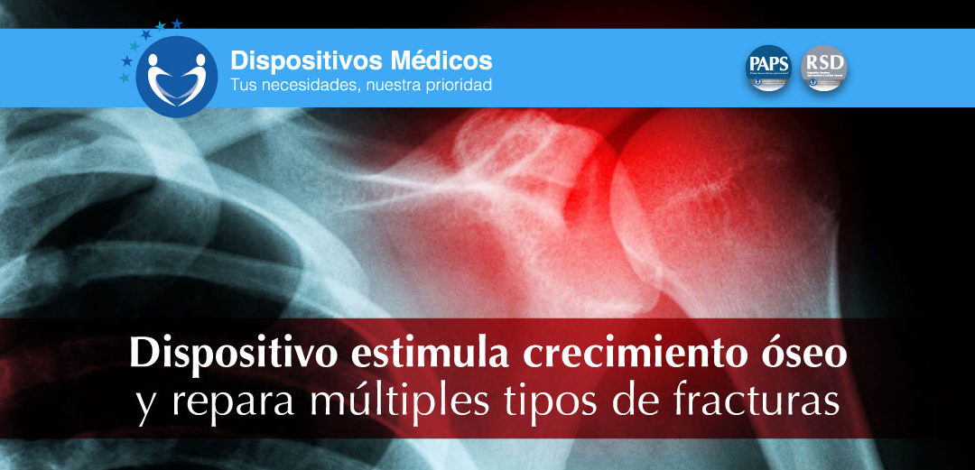 Dispositivo estimula crecimiento óseo y repara múltiples tipos de fracturas.