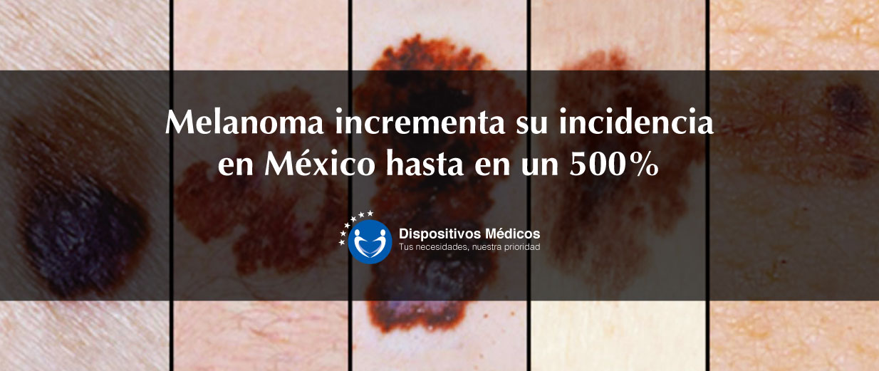 Melanoma ha incrementado incidencia en México hasta en un 500%.