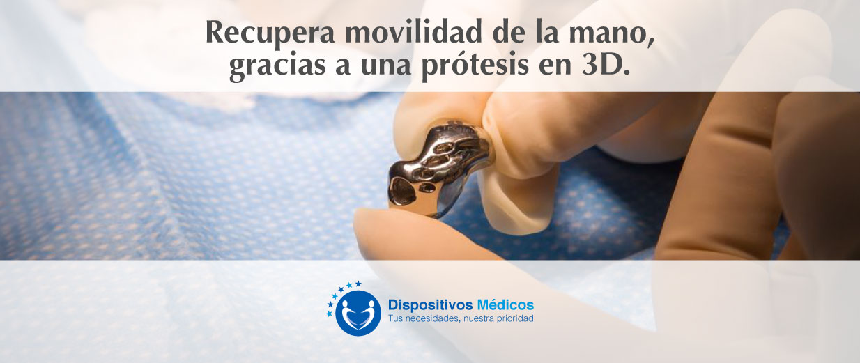 Hombre recupera movilidad de la mano, gracias a una prótesis en 3D.