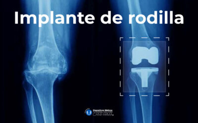 Implante de rodilla.