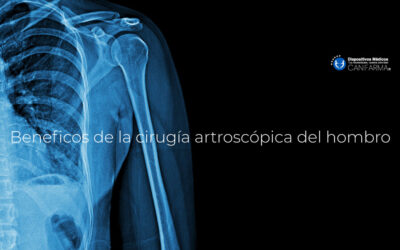Beneficos de la cirugía artroscópica del hombro