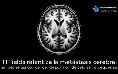 TTFields ralentiza la metástasis cerebral en pacientes con cáncer de pulmón de células no pequeñas
