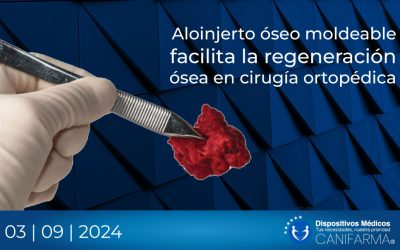 Aloinjerto óseo moldeable facilita la regeneración ósea en cirugía ortopédica